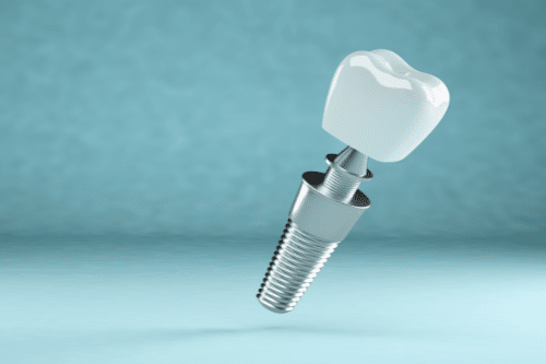 dental implants