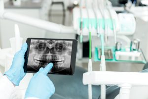 Demystifying Dental X-Rays: Understanding Their Role in Oral Heal